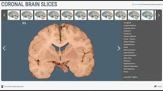 Neuroanatomy  Basal Ganglia in Brain Cross Sections [upl. by Cherry]