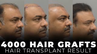 Shocking Transformation Hair Transplant BeforeAfter  Trichometric Sapphire FUE caraclinic [upl. by Curcio]