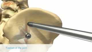 Why SImmetry Is More Effective Than Other SI Joint Fusions [upl. by Sulihpoeht928]