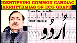 Identifying Common cardiac arrhythmias on ECG graph  Lectures by Dr Alamzeb [upl. by Luigino]