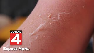 Avoid painful sunburns Learn from Dr Frank McGeorge’s mistake [upl. by Buddy607]