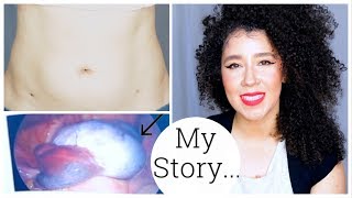 Im Back  My Ovarian Cyst Story  Ovarian Torsion  Laparoscopy Surgery [upl. by Natanoj]