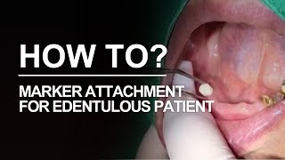 Marker attachment for edentulous condition DIOnavi Learning Contents [upl. by Ennazzus]