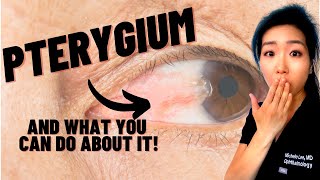 What Is A Pterygium  Causes Symptoms And Treatments For Surfers Eye [upl. by Fattal]