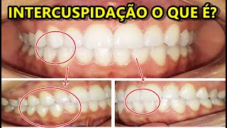 Intercuspidação dos dentes o que é [upl. by Hannavas583]