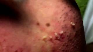 Acne Solution  Blackheads amp Whiteheads Removal 1  How to get rid of acne [upl. by Salocin]