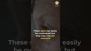 Cataract Symptoms amp Treatment Restore Your Vision with Modern Surgery  Jehangir Hospital [upl. by Keyek]