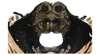 LTB Learning the Brainstem video 11 At the level of the facial colliculi part two [upl. by Onej683]
