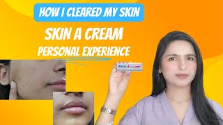 HOW I CLEARED MY SKIN  SKIN A CREAM  ACNE SOLUTION [upl. by Eicyac]