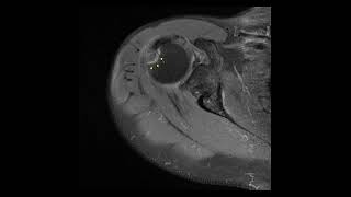 How nondisplaced GT fracture of humerus improve in 1 year [upl. by Elia824]