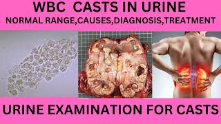 WBC CAST IN THE URINE CAUSES SYMPTOMS AND TREATMENT OF WBC CAST IN URINE EXAMINATIONURINE ROUTINE [upl. by Lynelle115]