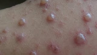 Chickenpox disease [upl. by Edbert]