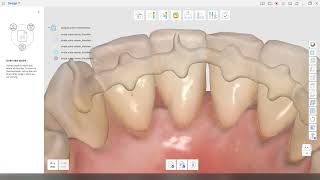 Designing a 3Dprintable orthodontic retainer using the Medit Design app [upl. by Wrench307]