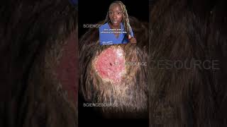 Is Your Scalp Itching Discover the Causes of Scalp Ringworm Tinea Capitis [upl. by Boggs]