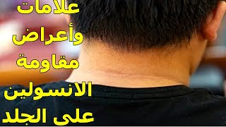 أعراض مقاومة الانسولين التى تظهرعلى الجلد  علامات يجب ملاحظتها والانتباه اليها [upl. by Melesa4]