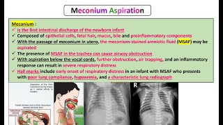 Meconium Aspiration [upl. by Nylra574]