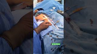 ANGIOGRAPHY  ANGIOPLASTY reels shorts doctor medical reel heart cardio Dr Raj Mishra neet [upl. by Chilt153]