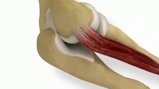 Muscle attachment of lateral epicondyle of elbow [upl. by Bennett]