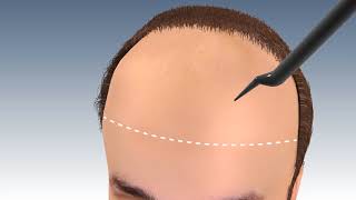 Step by Step FUE Hair Transplant Surgery in jaipur  Hair transplant in india  Outbloom clinics [upl. by Aubrey]