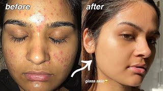 how i cleared my acne FOR GOOD something finally worked [upl. by Uchida]