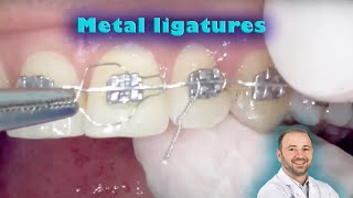 Braces preformed twisted ligature amp figure of 8 stainless steel ligating metal ligature placing on [upl. by Bilek]