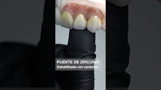 Puente de Zirconio estratificado con cerámica y cerámica de encía impresión dental guayaquil [upl. by Yelrehs]