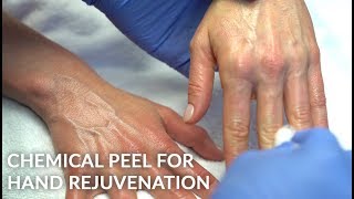 TCA PHENOL CHEMICAL PEEL FOR HAND WRINKLE AND SUN DAMAGE REJUVENATION  DR JASON EMER [upl. by Tnecniv513]