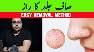 Dr ZeeHow To REMOVE Blackheads Permanently [upl. by Raye519]