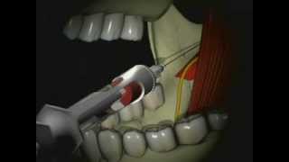 Mandibular Anesthesia  Inferior Alveolar Nerve Block [upl. by Bellina]