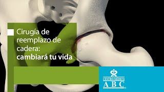 Prótesis de cadera tipos de implantes técnica y recuperación [upl. by Nyltak]