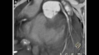 Cardiac diseased aortic valve with aortic valvular stenosis 1 of 10 [upl. by Heywood]