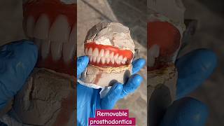 Removable prosthesis dentalcafe [upl. by Noskcaj]