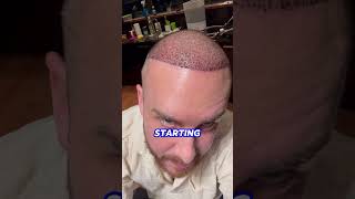 Day 4 Hair Transplant Recovery [upl. by Acire]