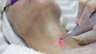 LUCID QPTP Carbon Peeling Treatment [upl. by Resarf]