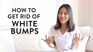 How to Get Rid of the White Bumps on Your Face  Peach amp Lily [upl. by Hillier]