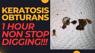 KERATOSIS OBTURANS  1 Year Of Hearing Loss Resolved 😮‍💨😮‍💨😮‍💨 [upl. by Longwood113]