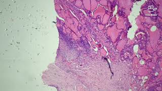 Goiter  Histopathology slides [upl. by Hale397]