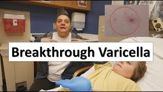 Breakthrough Varicella [upl. by Nonnah]