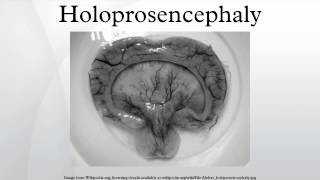 Holoprosencephaly [upl. by Pike]