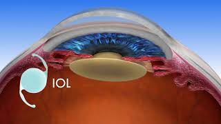 Florida Eye  LENSAR Laser Assisted Cataract Surgery [upl. by Kentigera]