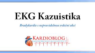 Kardioblog  EKG Kazuistika Bradykardie s nepravidelnou srdeční akcí [upl. by Adnauqal]