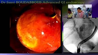 ERCP for advanced GB neoplasia [upl. by Yelich]