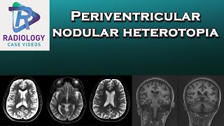 Periventricular nodular heterotopia [upl. by Ayrad]