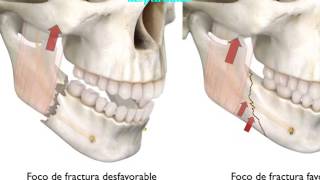 Fracturas Mandibulares [upl. by Carlo]