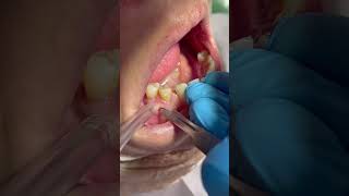 Ağız içi diş apse drenajı dental abscess drainage asmr [upl. by Trimble]