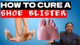 3 Awesome Steps To Cure A Blister on The Feet [upl. by Corissa609]