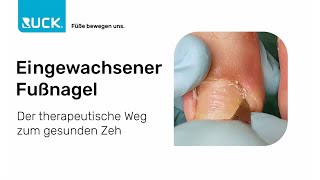 Eingewachsener Fußnagel  der therapeutische Weg zum gesunden Zeh [upl. by Ahseena]