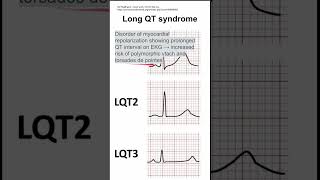 Long QT syndrome [upl. by Meehyrb]