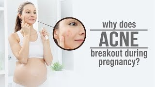 why does acne breakout during pregnancy [upl. by Darrelle]