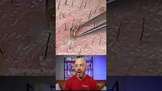 🚨 Ingrown Hair Alert 🚨 Watch as they conquer this gnarly skin invader DermReacts DoctorReacts [upl. by Brubaker743]